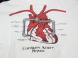 画像5: 80s Hanes HEART CORONARY ARTERY BYPASS PRINT T-SHIRT MADE IN USA (5)